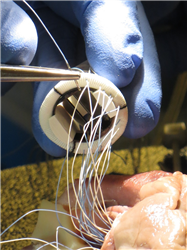 Suturing the Aortic Valve Sewing Cuff